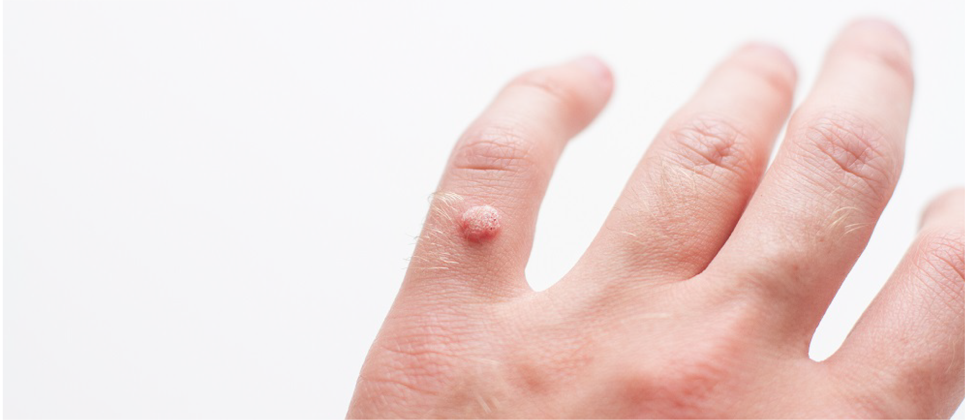 Professional Warts and Moles Removal Treatments | DR REBORN