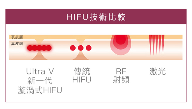 hifu技術