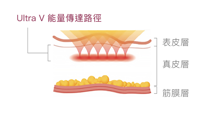 HIFU 原理