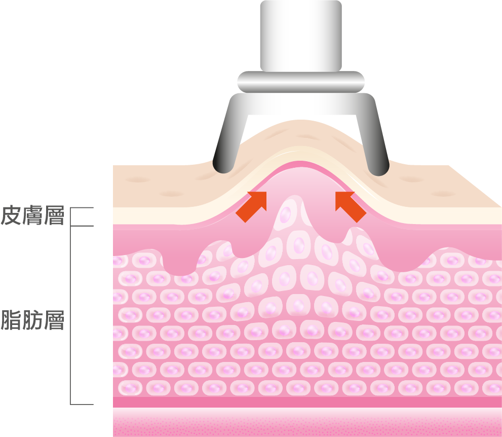 4in1溶脂技術