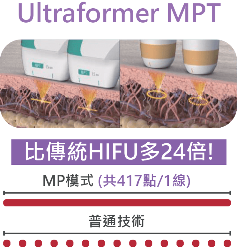 Ultraformer MPT