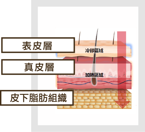 無痛高能量輸出​