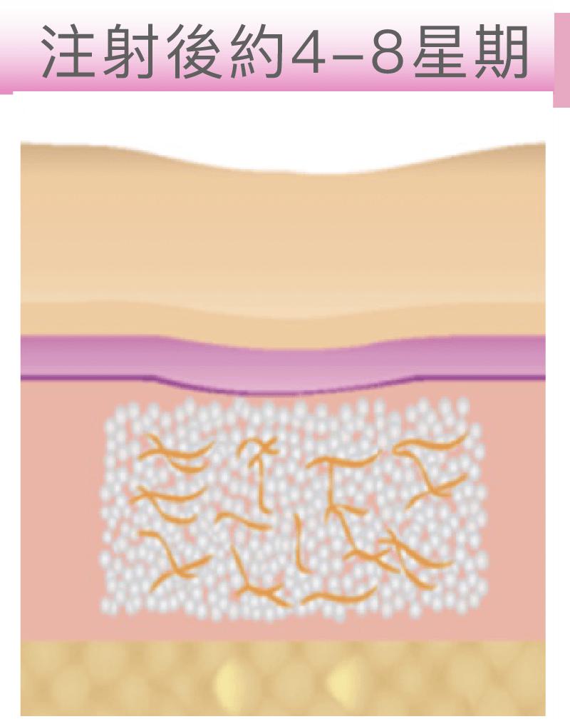 Aesthefill 膠原精靈針原理