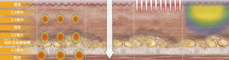 Ultherapy 可達皮下 4.5 mm筋膜層