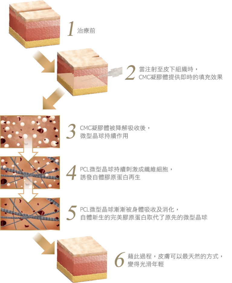 Ellanse 作用機制