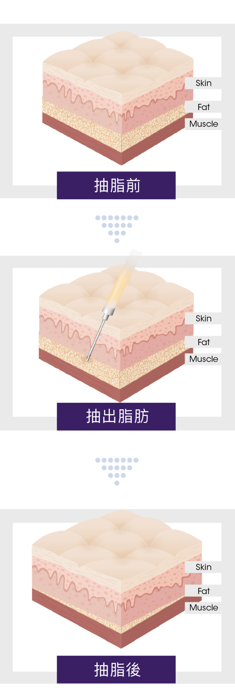 精準抽出體內深層的脂肪​